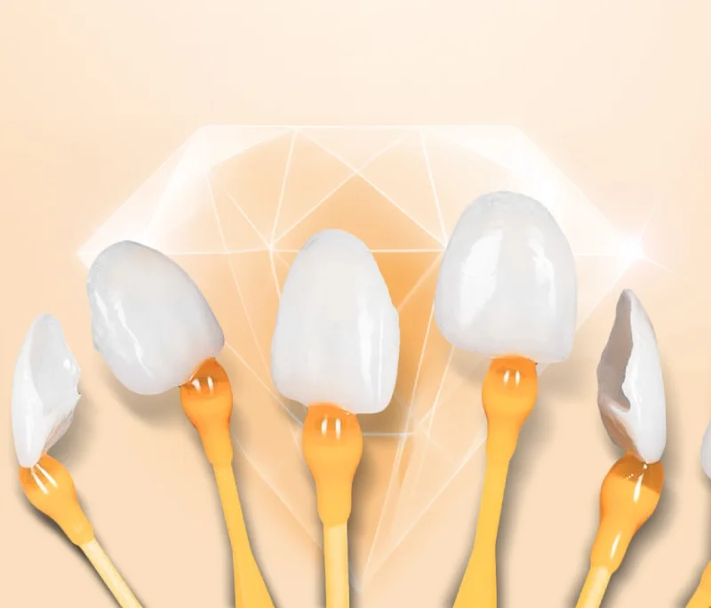 Dán Veneer có dễ rơi không? Độ bền của dán Verneer là bao nhiêu?